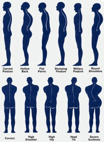 posture alignment therapy